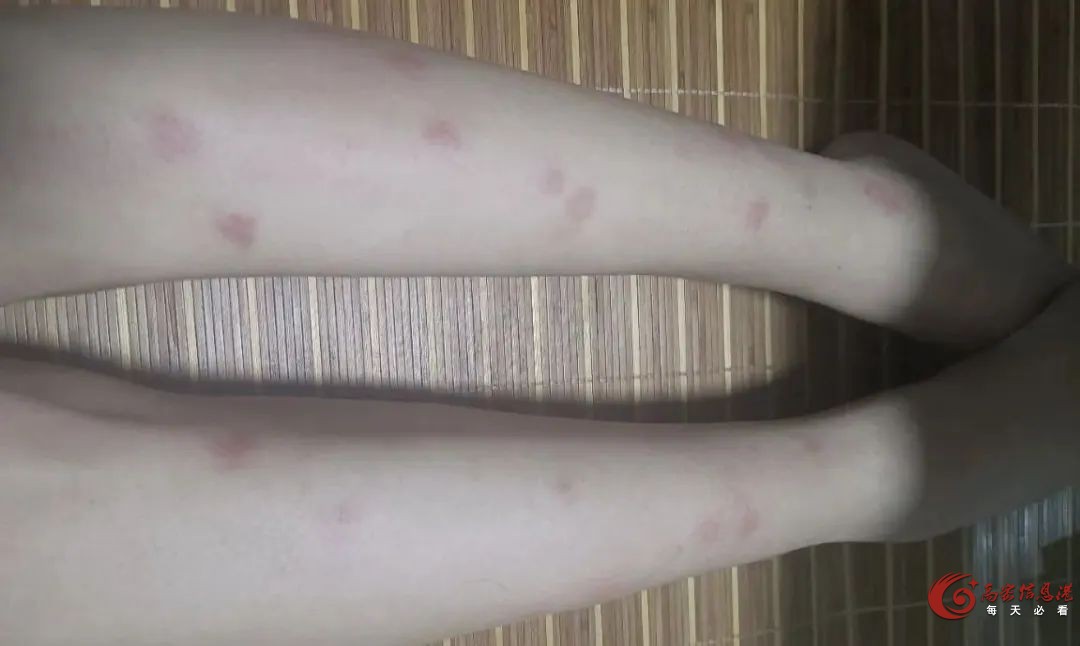 高密人注意！越抓越痒，最近很多人中招！